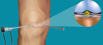 Dr Akhilesh Yadav Arthroscopic Knee Surge